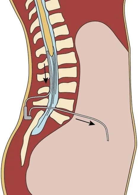 جراحات علاج الارتفاع الحميد بضغط المخ